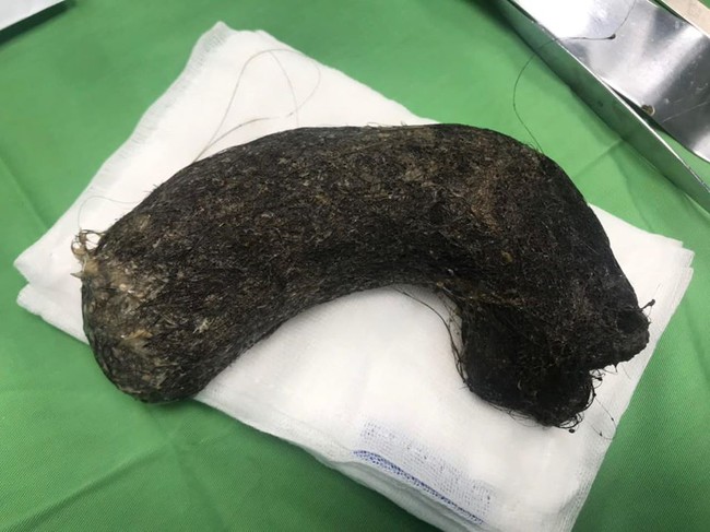 Bé gái 11 tuổi có biểu hiện đau bụng, buồn nôn, đi khám bác sĩ lấy ra búi tóc 1kg trong dạ dày