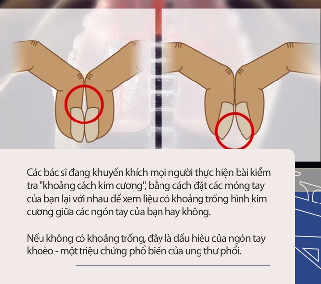 Bài kiểm tra đơn giản bằng 2 ngón tay có thể cho biết liệu bạn có nguy cơ bị ung thư phổi hay không - Ảnh 1.