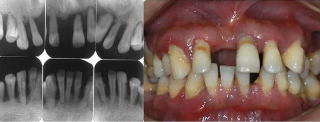 Người đàn ông 31 tuổi đi khám vì răng lung lay, nhưng bác sĩ lại nhổ tất cả răng vì sai lầm từ 2 năm trước của anh - Ảnh 4.