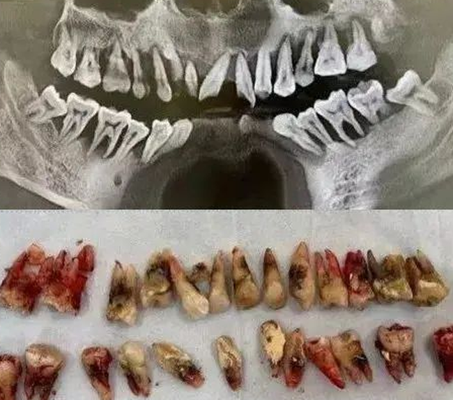 Người đàn ông 31 tuổi đi khám vì răng lung lay, nhưng bác sĩ lại nhổ tất cả răng vì sai lầm từ 2 năm trước của anh - Ảnh 1. Người đàn ông 31 tuổi đi khám vì răng lung lay, nhưng bác sĩ lại nhổ tất cả răng vì sai lầm từ 2 năm trước của anh - Ảnh 1.