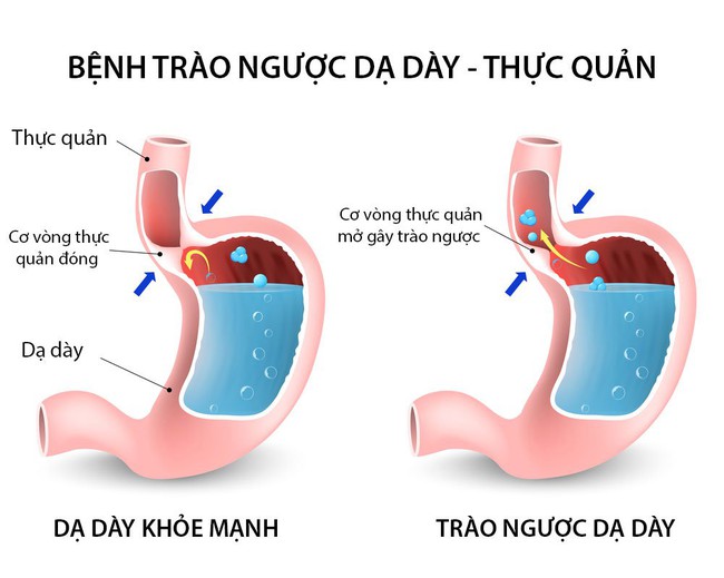 Trào ngược dạ dày: Bệnh của “thời đại mới” - Ảnh 1.