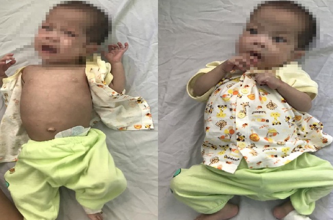 Teo ruột non bẩm sinh, bé 7 tháng tuổi suy dinh dưỡng nặng - Ảnh 1.