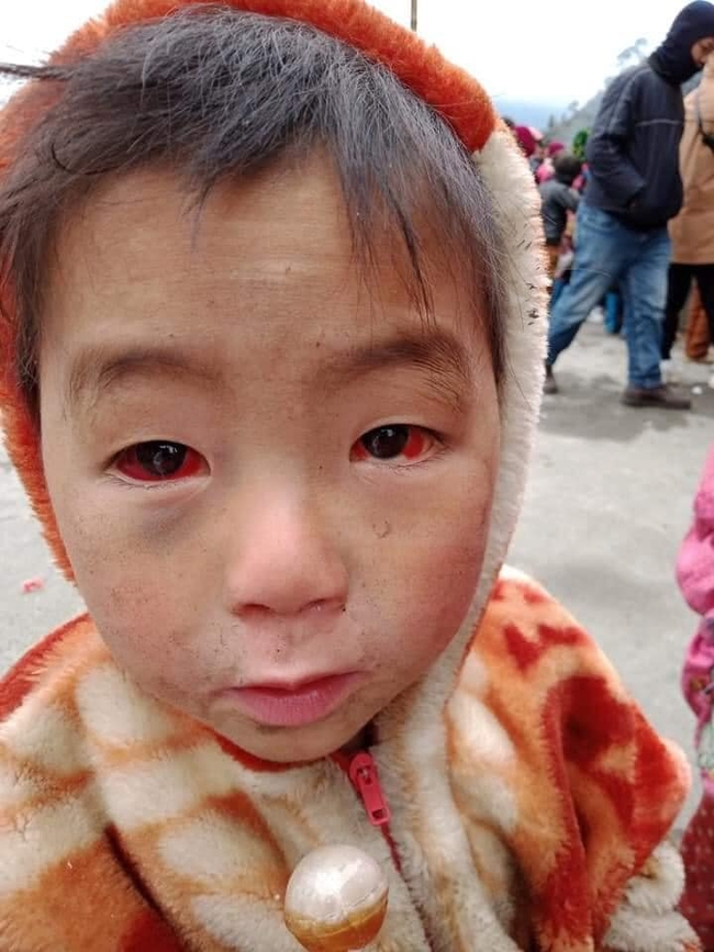 Tấm ảnh cháu bé miền núi phía Bắc "bị xuất huyết dưới kết mạc" do thời tiết rét lạnh đỏ ngầu cả 2 mắt: Bác sĩ chuyên khoa Mắt nói sự thật về nguyên nhân - Ảnh 1.