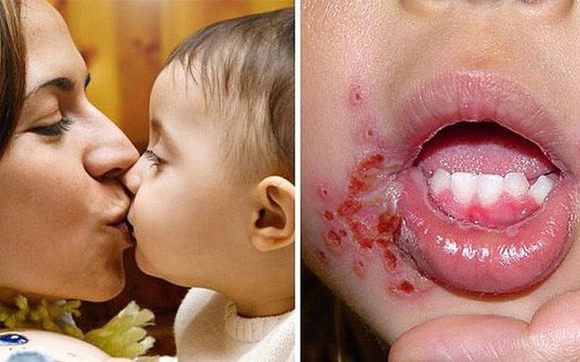 Bé gái 18 tháng tuổi bị nhiễm vi rút sinh dục từ nụ hôn của mẹ, cảnh báo không hôn trẻ khi mắc 9 tình huống này - Ảnh 2.