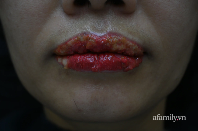 Xăm môi giá 2 triệu đồng đón Tết, cô gái 27 tuổi sưng phù miệng kinh dị, chảy mủ nặng nề - Ảnh 4.