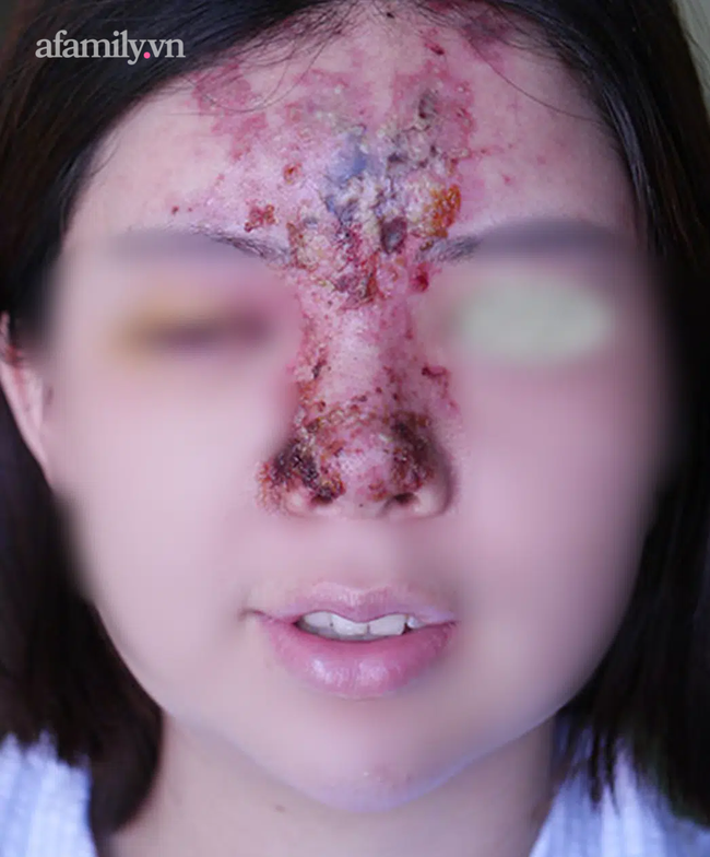 Nâng mũi bằng filler tại một spa ở TP.HCM, cô gái 24 tuổi giảm thị lực, mặt sưng tấy chảy dịch khủng khiếp - Ảnh 3.