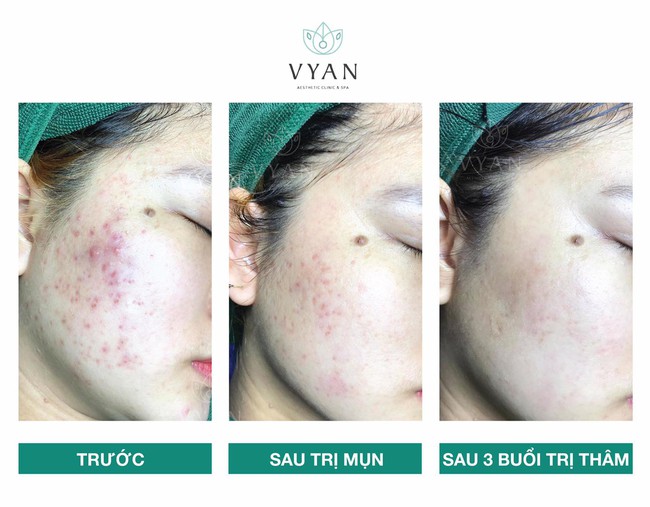 5 dịch vụ spa làm đẹp cấp tốc trước Tết, chị em ghim ngay để tranh thủ "tút tát" cho kịp - Ảnh 5. 5 dịch vụ spa làm đẹp cấp tốc trước Tết, chị em ghim ngay để tranh thủ "tút tát" cho kịp - Ảnh 5.
