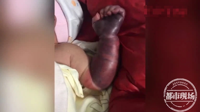 Cánh tay của bé 1 ngày tuổi bỗng nhiên bầm đen, gia đình đưa đến bệnh viện mới biết do sự cẩn thận quá mức của người mẹ - Ảnh 1.