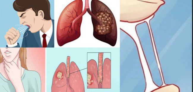 Thường xuyên xuất hiện 4 triệu chứng này thì có thể bạn đã bị üɳġ ʈɧư phổi rồi, nhiều người rất dễ nhầm lẫn và hay bỏ qua dấu hiệu 3 - Ảnh 1.
