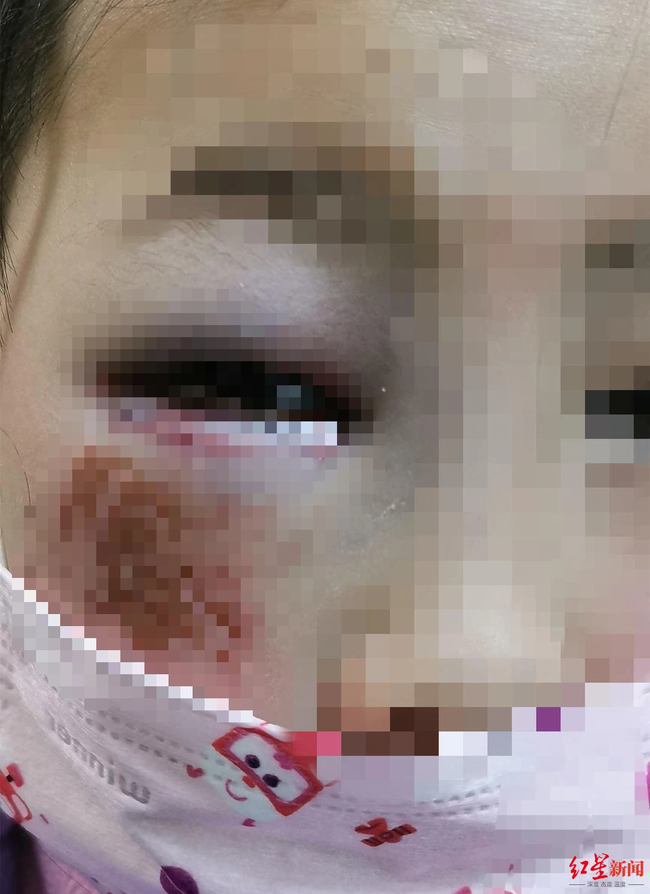 Bé gái 8 tuổi bị cô giáo đánh đến mức suýt mù chỉ vì làm Toán sai, hình ảnh được chia sẻ khiến phụ huynh phẫn nộ - Ảnh 1.