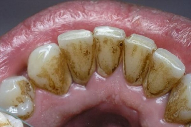 Có 4 dấu hiệu này ở miệng thì coi chừng cao răng đang &quot;bành trướng&quot;, gây ê buốt lẫn hàng tá bệnh nha chu - Ảnh 1.