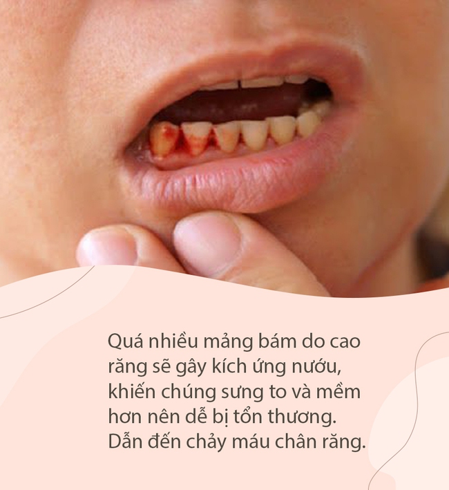 Có 4 dấu hiệu này ở miệng thì coi chừng cao răng đang &quot;bành trướng&quot;, gây ê buốt lẫn hàng tá bệnh nha chu - Ảnh 3.