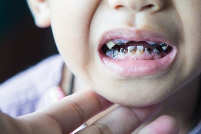 Trẻ bị sâu răng nguy hiểm hơn cha mẹ nghĩ, đây là 5 mối nguy hại khi răng trẻ bị hiện tượng này từ sớm - Ảnh 1. 5 mối nguy hại lớn khi trẻ bị sâu răng và những cách giúp phòng chống - Ảnh 1.