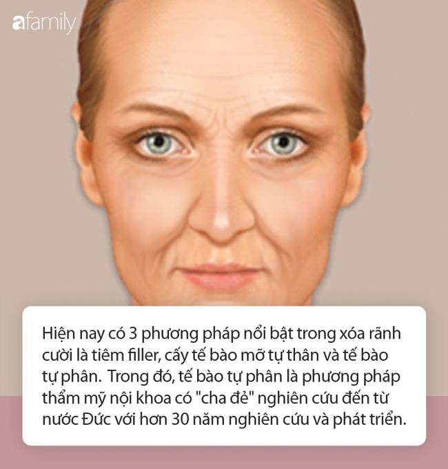 Ngoài tiêm filler và tế bào tự thân, chuyên gia &quot;bật mí&quot; phương pháp có ưu điểm vượt trội, hiệu quả kéo dài hàng chục năm - Ảnh 2.