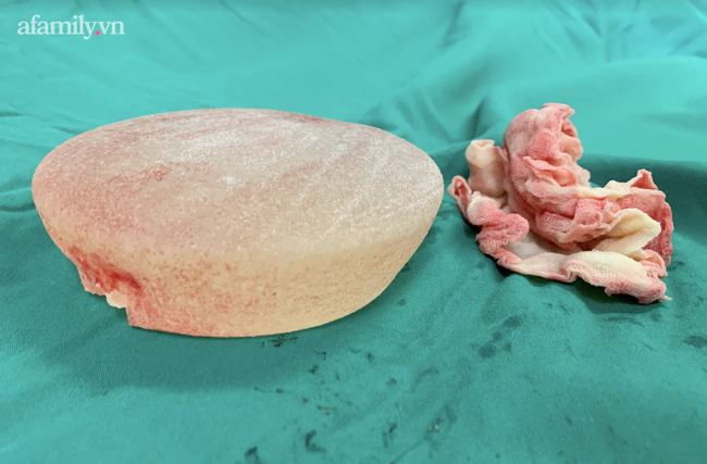 Kinh hoàng: Nữ bệnh nhân bị spa bỏ quên miếng gạc trong người suốt 1 tháng, ngực lở loét chảy dịch khủng khiếp - Ảnh 7.