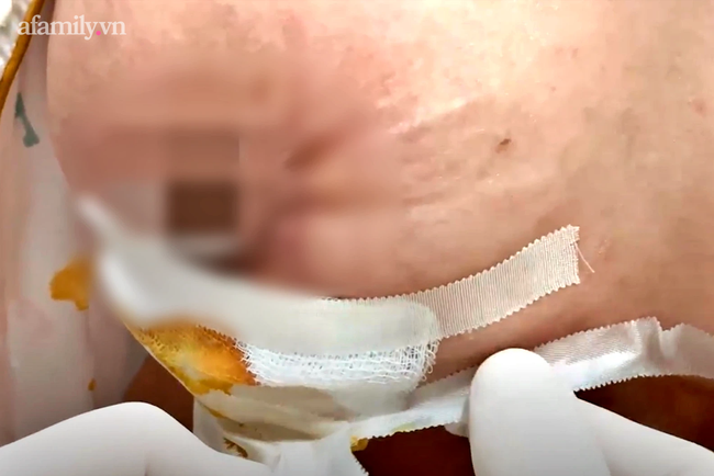 Kinh hoàng: Nữ bệnh nhân bị spa bỏ quên miếng gạc trong người suốt 1 tháng, ngực lở loét chảy dịch khủng khiếp - Ảnh 2.