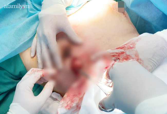 Sở Y tế TP.HCM vào cuộc vụ người phụ nữ bị spa bỏ quên miếng gạc trong ngực gây thủng lỗ, chảy dịch nặng nề - Ảnh 2.