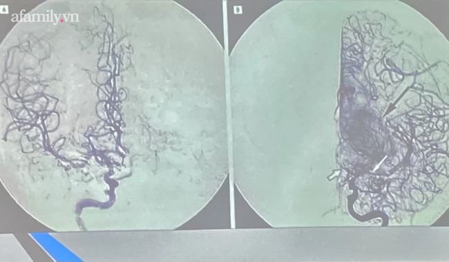 Bé gái 5 tuổi bất ngờ đột quỵ vì căn bệnh Moyamoya hiếm gặp, 100.000 trẻ mới có một trường hợp mắc phải - Ảnh 2.