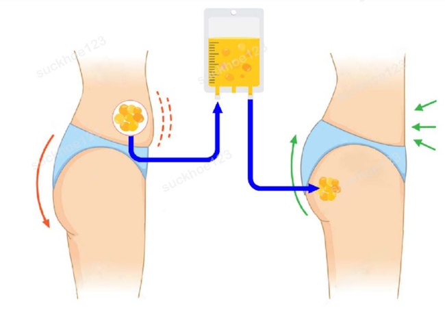 Nâng mông kiểu Brazil có gì hay mà chị em muốn cải thiện vòng 3 đều muốn thử? - Ảnh 8.