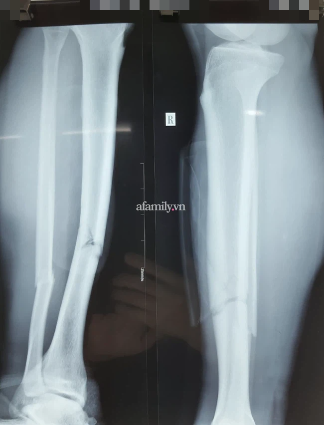 Sự thật bức ảnh chụp X-quang gãy rời 2 chân của Hùng Dũng gây sốc trên MXH - Ảnh 3.