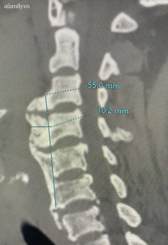 Nuốt nghẹn lâu ngày khi ăn nhưng tưởng bị viêm họng, người phụ nữ bất ngờ phát hiện vôi hóa cột sống cổ - Ảnh 1.