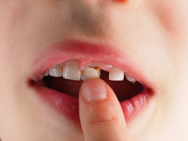 Bé gái 8 tuổi tự nhiên kêu đau răng, bà kiểm tra thì &quot;ngã ngửa&quot; khi thấy hàm dưới của cháu mọc thành 2 hàng - Ảnh 5.