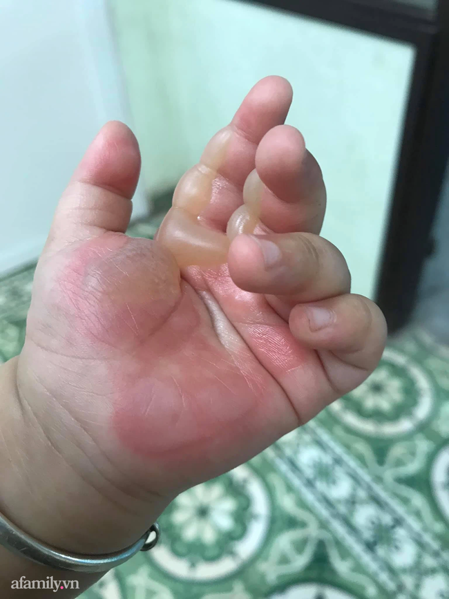 Bé 14 tháng tuổi bị bỏng bô phồng rộp 2 ngón tay: 2 loại thuốc cần có trong nhà và lưu ý không thể bỏ qua để phòng tránh di chứng do bỏng mang lại - Ảnh 1.