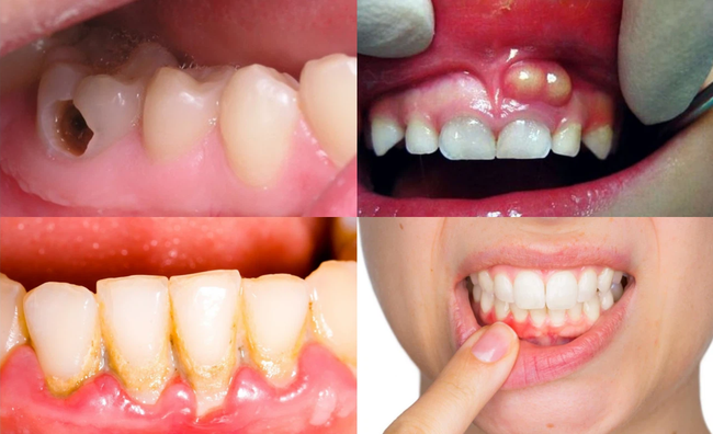 Trẻ có những dấu hiệu nào khiến bố mẹ phải để ý về thẩm mỹ hàm răng ngay từ khi còn bé? - Ảnh 2. Trẻ có những dấu hiệu nào khiến bố mẹ phải để ý về thẩm mỹ hàm răng ngay từ khi còn bé? - Ảnh 2.