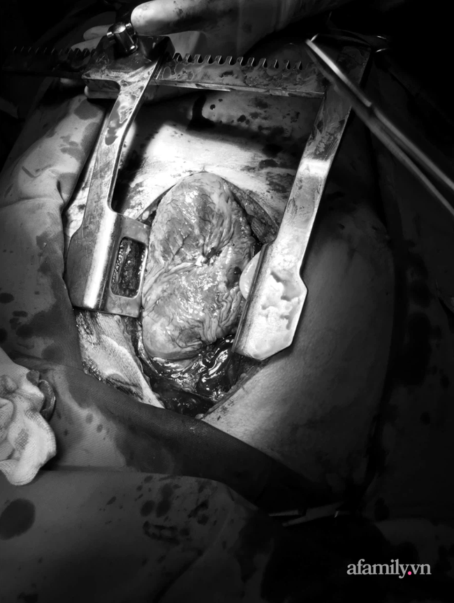 Cấp cứu người đàn ông bị kéo đâm thủng tim máu phun thành vòi, 3 lần tim ngừng đập lúc 0 giờ - Ảnh 2.