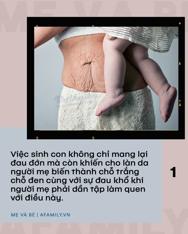 Bức ảnh chiếc bụng rạn đen sau khi sinh 10 ngày và câu chuyện sinh nở của hơn 1000 người mẹ khác khiến ai cũng phải trầm ngâm suy nghĩ - Ảnh 2. Bức ảnh chiếc bụng rạn đen sau khi sinh 10 ngày và câu chuyện sinh nở của hơn 1000 người mẹ khác khiến ai cũng phải trầm ngâm suy nghĩ - Ảnh 2.