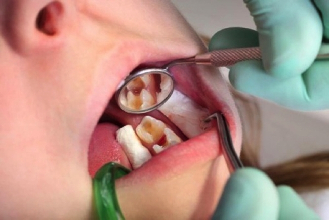 Nếu mặc kệ sâu răng và chờ rụng thay răng mới, trẻ sẽ gánh hậu quả gì? - Ảnh 19.
