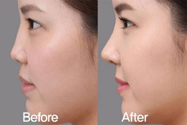 Nâng mũi bằng filler: Những biến chứng cần lường trước để cân nhắc trước khi làm - Ảnh 2.