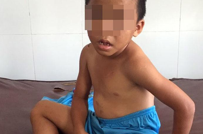 Bé trai 6 tuổi ở Sóc Trăng bị cha dượng bạo hành dã man - Ảnh 1.