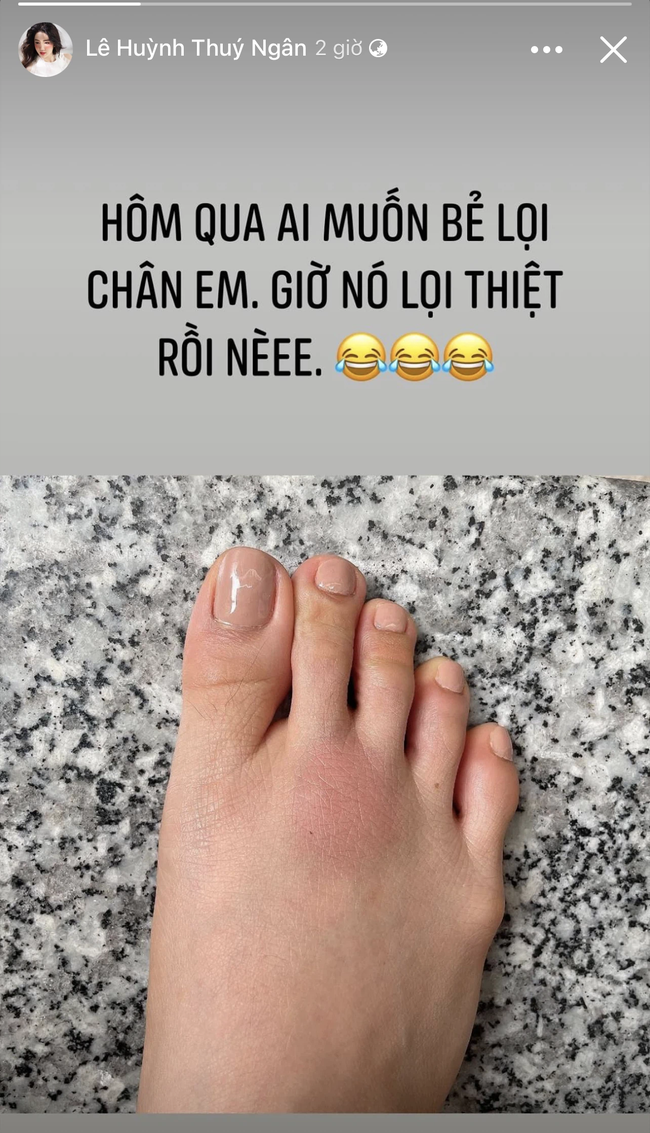 Ngô Kiến Huy, Thúy Ngân đồng loạt khoe ảnh cơ thể bầm dập, netizen nôn nao chờ xem những màn xé bảng tên khốc liệt ở "Running Man Vietnam" - Ảnh 6. Ngô Kiến Huy, Thúy Ngân đồng loạt khoe ảnh cơ thể bầm dập, netizen nôn nao chờ xem những màn xé bảng tên khốc liệt ở "Running Man Vietnam" - Ảnh 6.