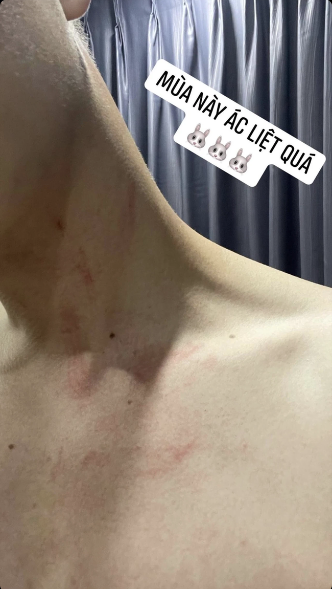 Ngô Kiến Huy, Thúy Ngân đồng loạt khoe ảnh cơ thể bầm dập, netizen nôn nao chờ xem những màn xé bảng tên khốc liệt ở "Running Man Vietnam" - Ảnh 5. Ngô Kiến Huy, Thúy Ngân đồng loạt khoe ảnh cơ thể bầm dập, netizen nôn nao chờ xem những màn xé bảng tên khốc liệt ở "Running Man Vietnam" - Ảnh 5.