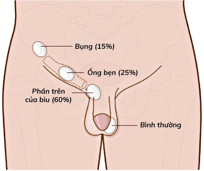 Bé bị ẩn tinh hoàn nay 15 tháng thì thăm khám ở đâu tốt? - Ảnh 2.