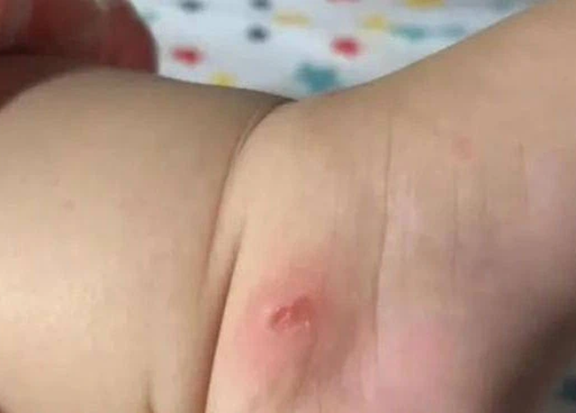 Bà mẹ sốc khi thấy người lạ véo con gái 4 tháng tuổi đến hoại tử cả da chân khi đi siêu thị - Ảnh 2. Bà mẹ sốc khi thấy người lạ véo con gái 4 tháng tuổi đến hoại tử cả da chân khi đi siêu thị - Ảnh 2.