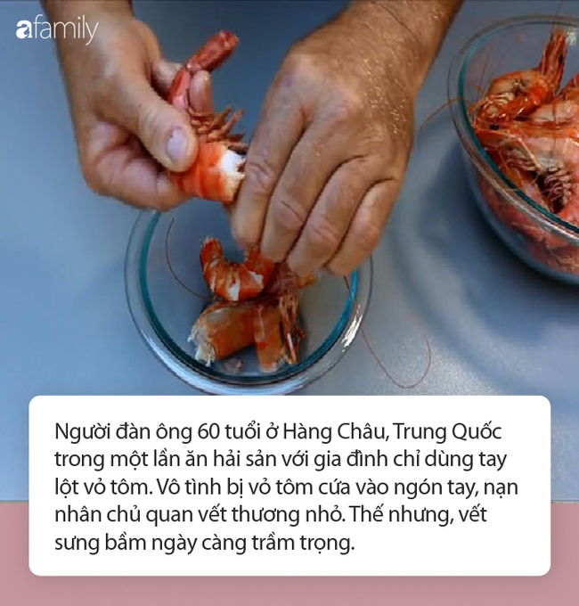 Chỉ làm duy nhất việc này trước khi ăn tôm và người đàn ông tử vong: Chuyên gia cảnh báo nguy cơ khi ăn hải sản có vỏ! - Ảnh 3. Chỉ làm duy nhất việc này trước khi ăn tôm và người đàn ông tử vong: Chuyên gia cảnh báo nguy cơ khi ăn hải sản có vỏ! - Ảnh 3.