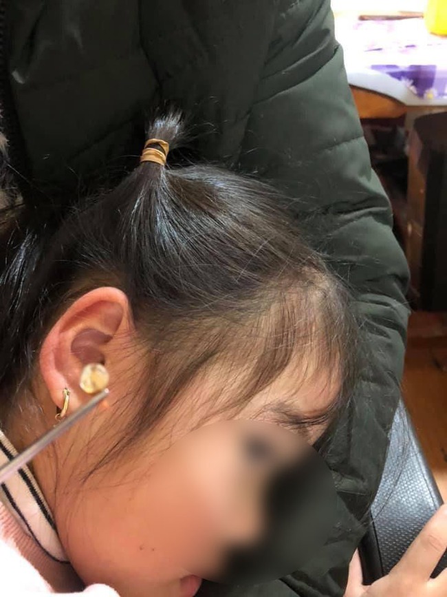 Rùng mình xem cảnh gắp dị vật to "chà bá", nảy mầm tươi tốt trong lỗ tai bé trai - Ảnh 4. Rùng mình xem cảnh gắp dị vật to "chà bá", nảy mầm tươi tốt trong lỗ tai bé trai - Ảnh 4.