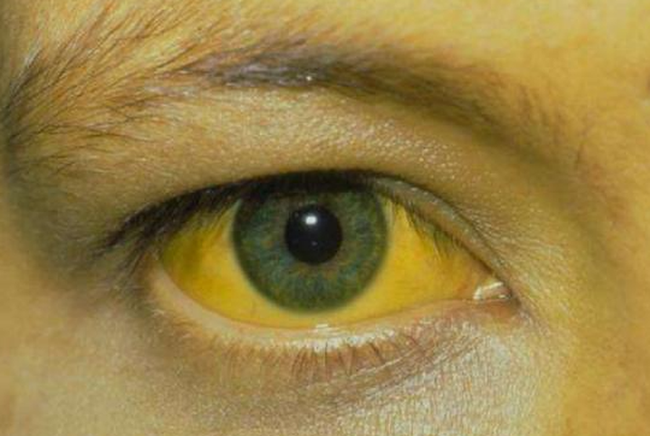 Mắt có mối quan hệ mật thiết với gan, nếu có 3 biểu hiện ở mắt, cần phải đi kiểm tra gan kịp thời - Ảnh 3.