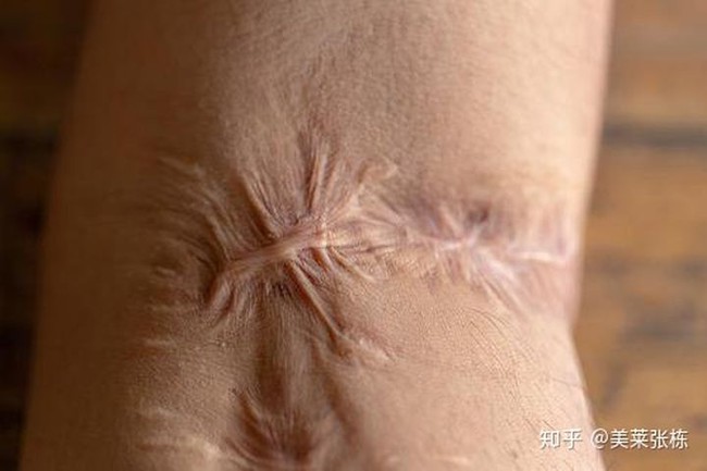 Một vết sẹo của người phụ nữ đã phát triển thành ung thư, Bác sĩ nhắc nhở: Ba loại sẹo trên cơ thể cần được điều trị nhanh chóng, nếu không chúng có thể trở thành ung thư - Ảnh 4.