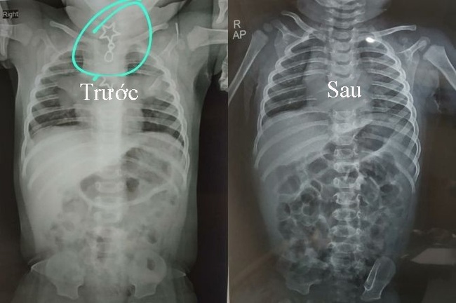 Đang chơi với bố, bé trai 8 tháng tuổi đột nhiên bị ngạt thở vì một vật đủ để khiến bác sĩ toát mồ hôi hột khi nhìn thấy - Ảnh 1.