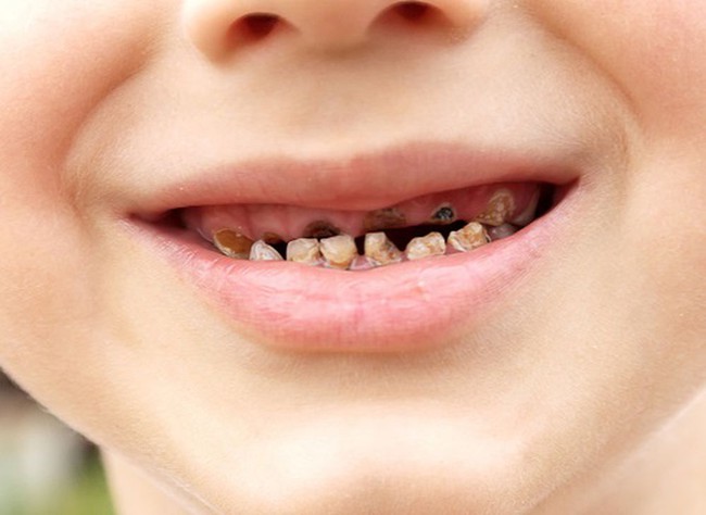 Không ăn bánh kẹo và đánh răng đều đặn 2 lần/ngày, bé trai 3 tuổi vẫn bị sâu cả hàm chỉ vì lỗi của mẹ - Ảnh 1.