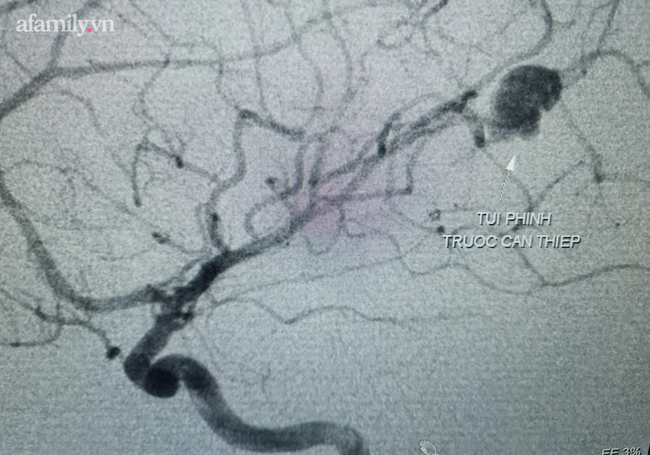 Bé trai mới 11 tuổi đã bị vỡ túi phình mạch máu não nguy kịch - Ảnh 1.