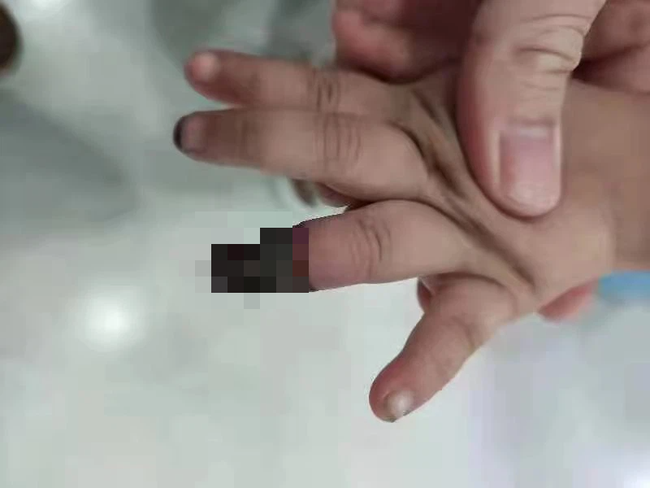 Cháu gái 3 tuổi bị hoại tử phải cắt ngón tay vì hành động sai lầm của bà, hình ảnh được chia sẻ khiến phụ huynh đau xót - Ảnh 1.
