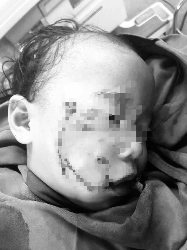 Nghệ An: Cháu bé 3 tuổi bị chó nhà cắn nát vùng mặt - Ảnh 1.