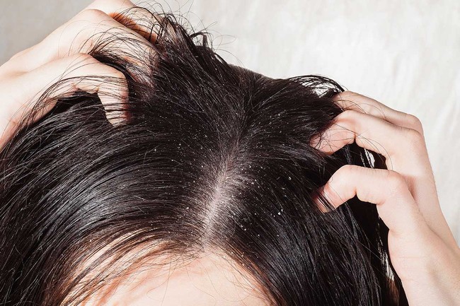 Tóc dầu: Thêm thành phần này khi gội đầu, tóc giảm bết dính,  - Ảnh 5.