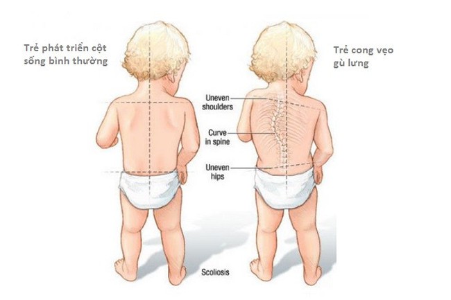 Cong vẹo cột sống ở trẻ em: Nguyên nhân, triệu chứng và cách phòng ngừa - Ảnh 3.