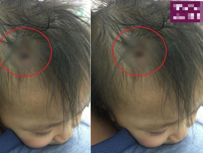 Thực hư hình ảnh chiếc đinh găm vào đầu cháu bé nghi trong vụ bạo hành ở Hà Nội đang lan truyền trên MXH - Ảnh 2.