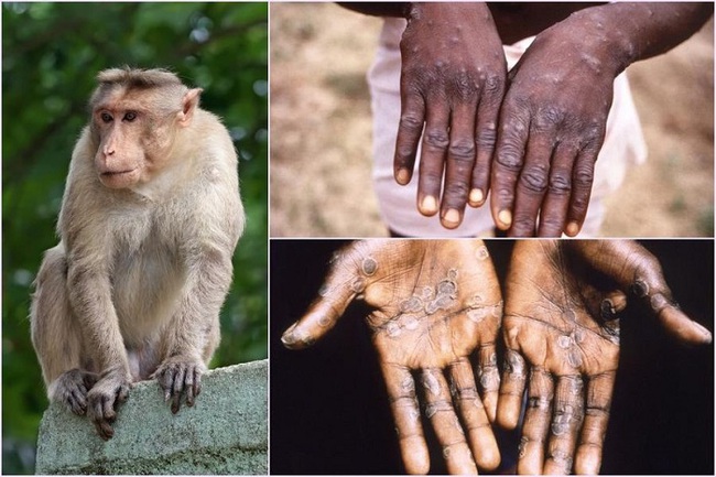 Bệnh đậu mùa khỉ lây truyền như thế nào và các dấu hiệu nhận biết - Ảnh 1.